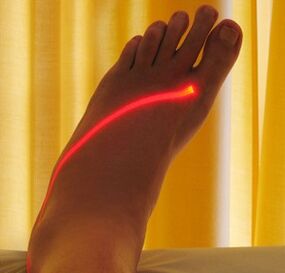 bacaklarda varis lazer tedavisi