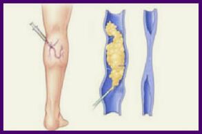 Skleroterapi, bacaklardaki varislerden kurtulmanın popüler bir yöntemidir. 