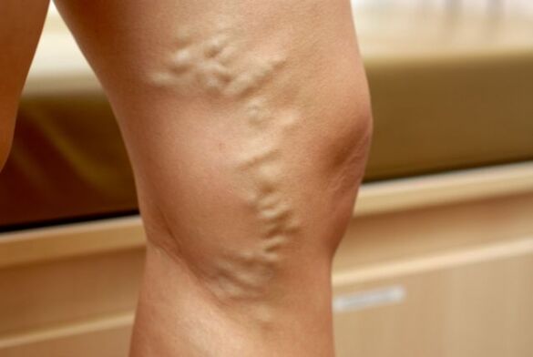 küçük pelvisin varisli damarları olan bacaktaki varisli damarlar