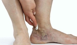 bacaklarda varisli damarların belirtileri